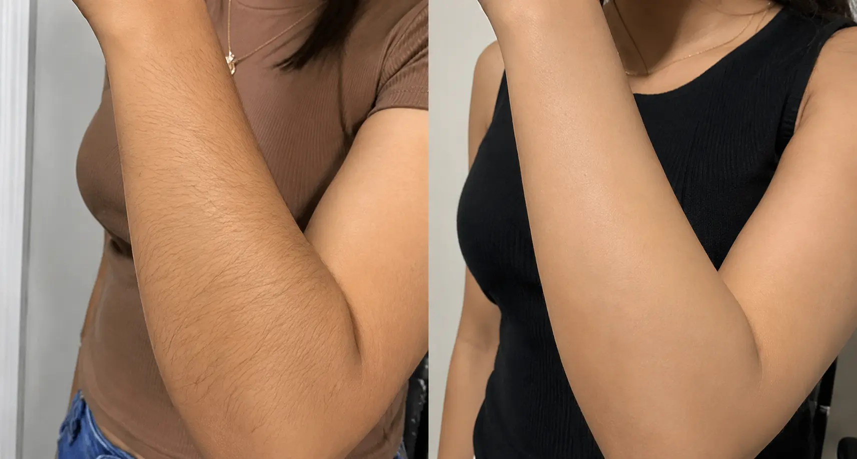 Before and after arm comparison showing complete hair reduction and smooth skin following laser hair removal treatment at Enfield Royal Medspa in Branchburg, serving Somerset County.