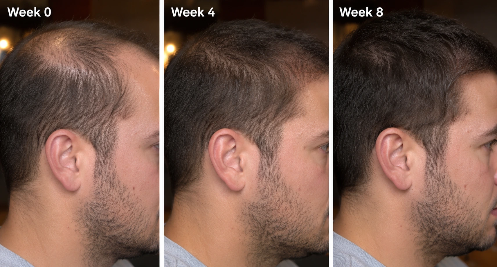 Progressive comparison from Week 0 to Week 8 showing hair growth and restoration results following PRP therapy at Enfield Royal Medspa in Branchburg, serving Somerset County.