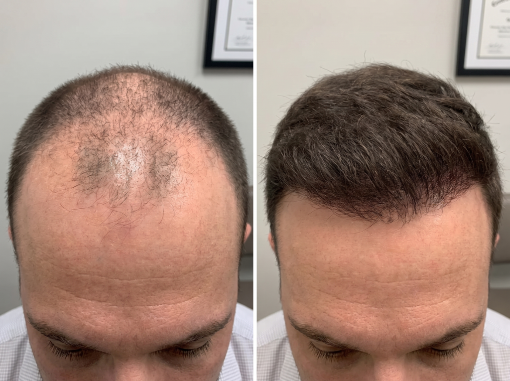 Before and after comparison of hairline treated with PRP hair restoration in Bridgewater, NJ