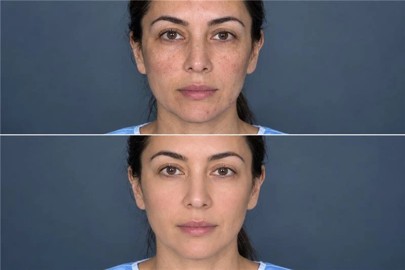 Before and after photos in Hydra Facial Before After.webp showing a woman achieving smoother, brighter skin post-treatment
