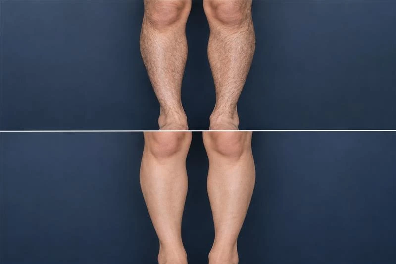 Laser hair removal before and after showing reduced leg hair and smoother-looking skin at Enfield Royal Clinic near Somerville, NJ.