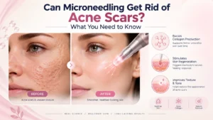 Microneedling for acne scars showing improved skin texture and collagen renewal at Enfield Royal Clinic in New Jersey