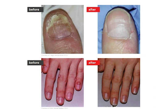 Before and after comparison of fingernails showing visible improvement in nail discoloration and appearance following laser treatment for nail fungus.