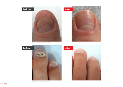Before and after comparison showing improved appearance of fingernails and toenails following laser treatment for nail fungus.