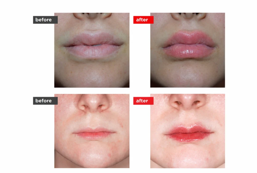 LipLase laser treatment before and after results showing improved lip fullness, definition, and a rosier appearance.