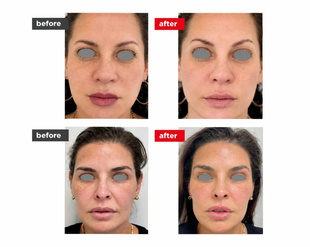 VectorLift non-surgical laser eyebrow lift before-and-after comparison showing changes in facial appearance, brow area, and overall skin smoothness.