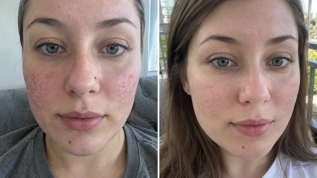 Before and after comparison showing changes in the appearance of facial acne scars and uneven skin texture
