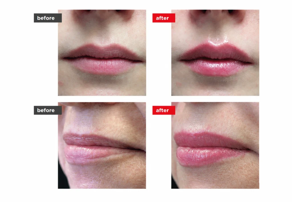 LipLase laser treatment before and after comparison showing fuller-looking, rosier lips with enhanced definition and a glossy appearance.