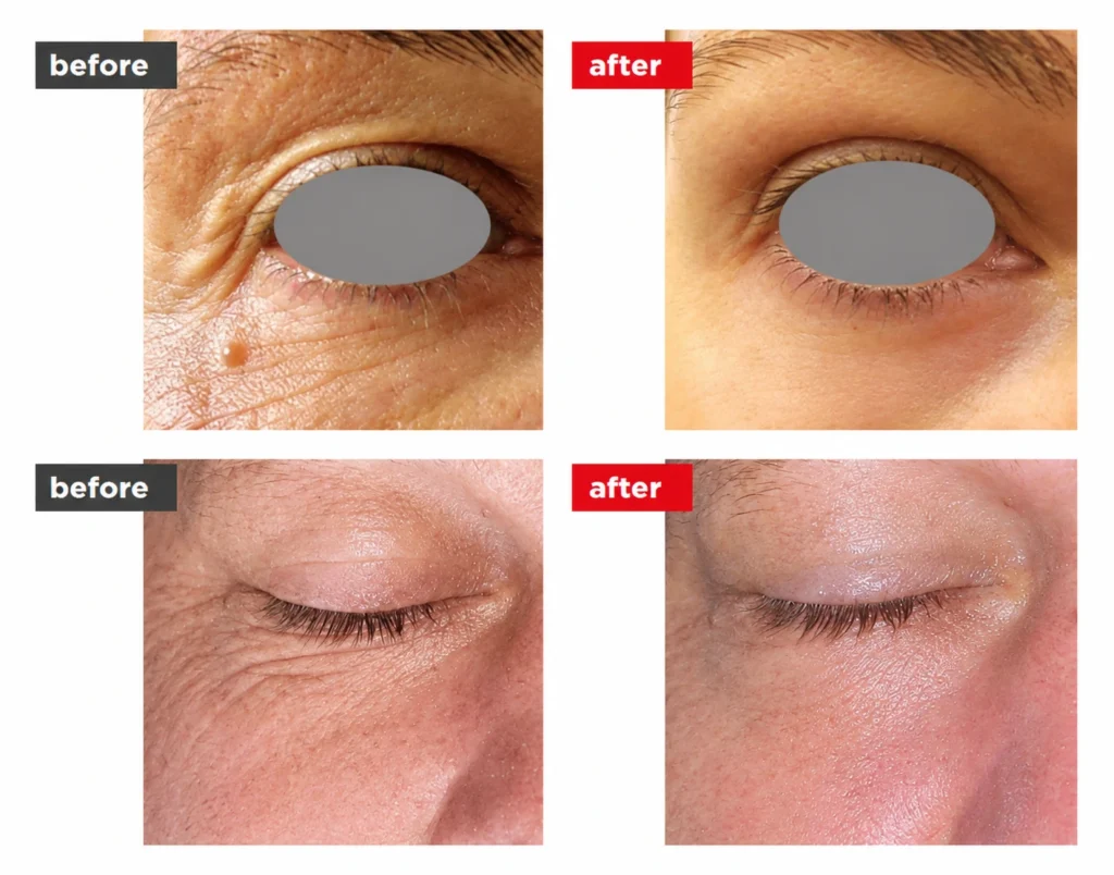 Close-up of the eye area for SmoothEye laser tightening treatment, showing the eyelid, eyelashes, eyebrow, and surrounding skin.