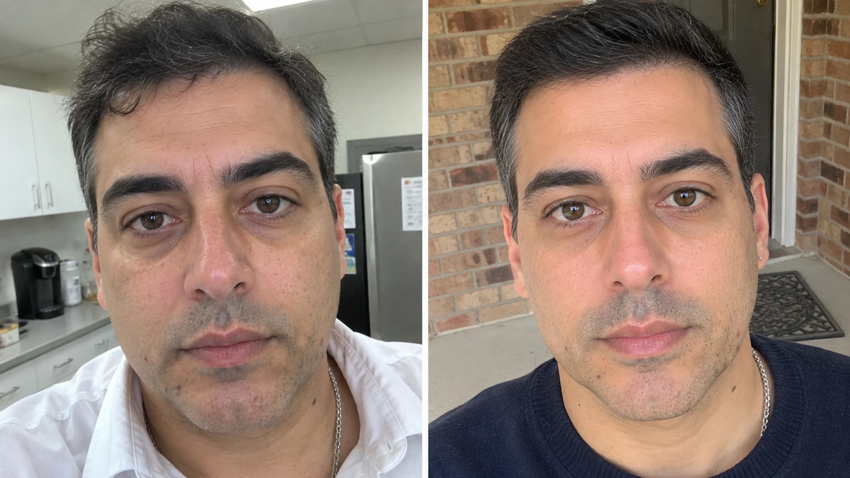 Before and after facial appearance following rejuvenation treatment in Somerville, NJ