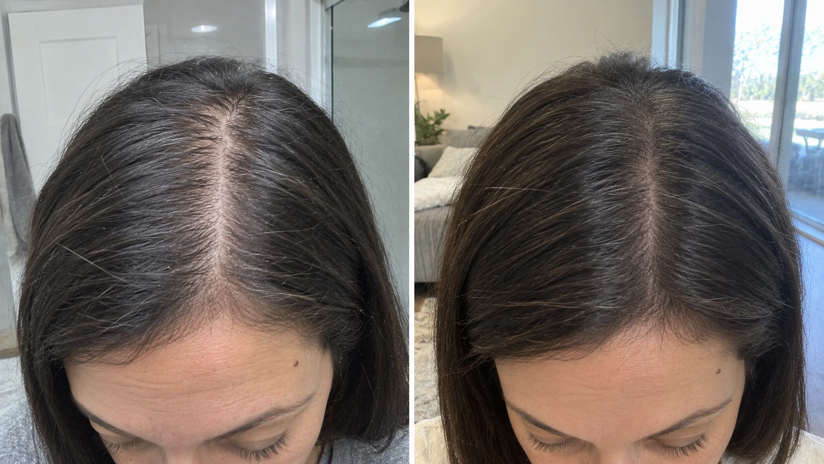 Before and after comparison of hair part and scalp appearance following treatment in Somerville, NJ