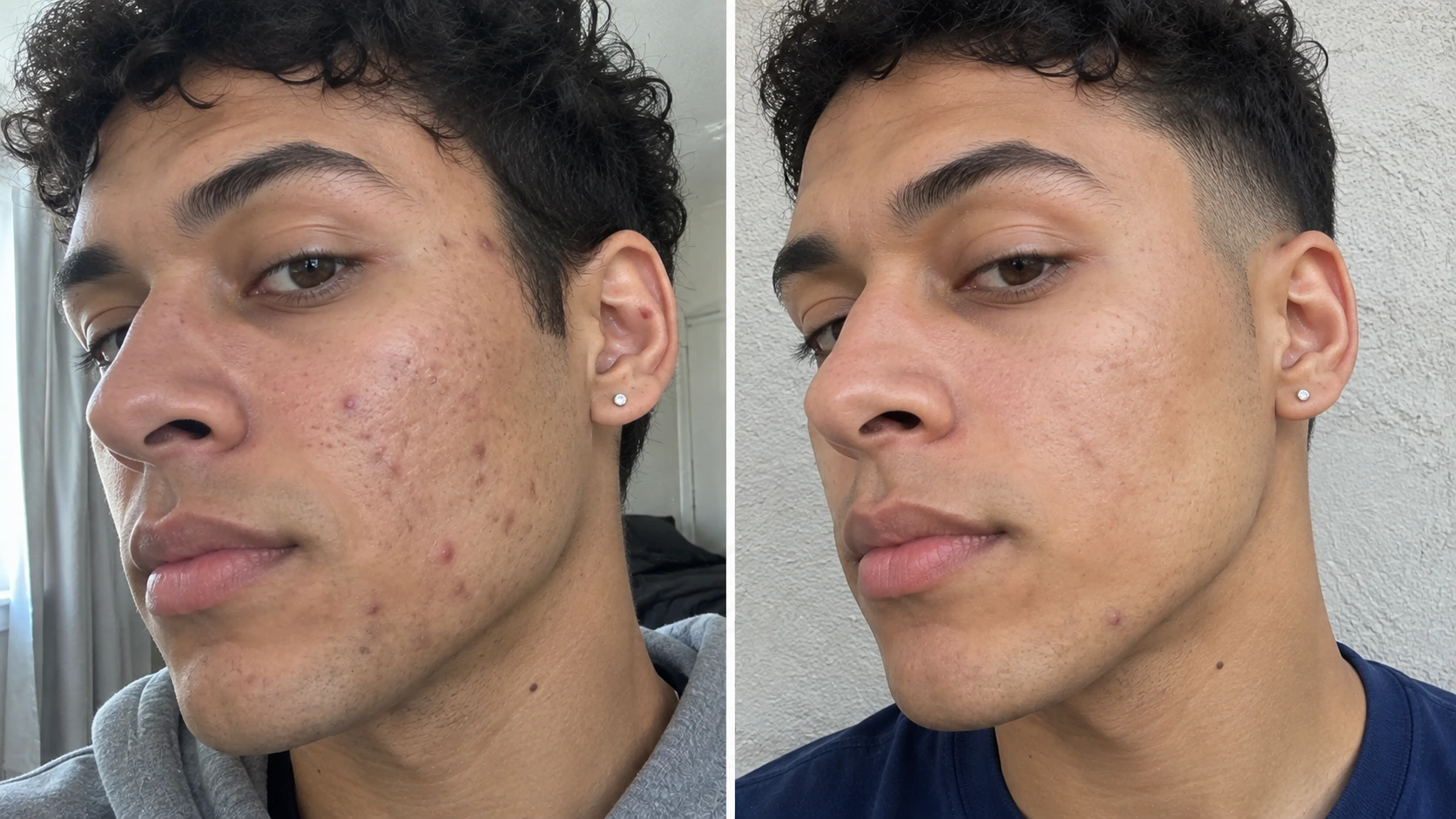 Before and after skin appearance following aesthetic treatment in Somerville, NJ