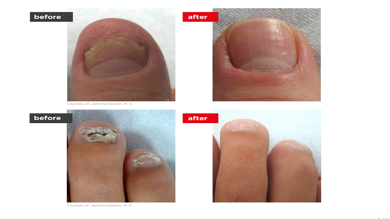 ClearSteps laser nail fungus treatment on a toenail at Enfield Royal Clinic in Branchburg, NJ