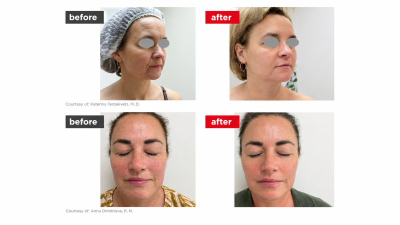 Fotona4D non-surgical laser facelift of the cheek and jawline at Enfield Royal Clinic, Branchburg, NJ