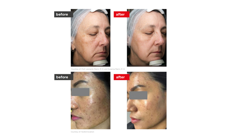 FracRevive laser treatment for skin tone, sun damage, and texture on the face at Enfield Royal Clinic, NJ