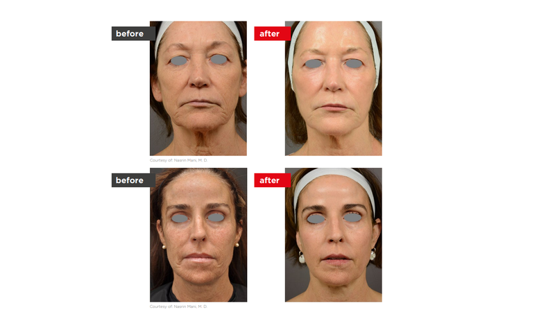 Er:YAG laser skin resurfacing for fine lines on the face at Enfield Royal Clinic in Branchburg, NJ
