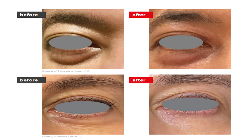 SmoothEye Laser Eye Tightening NJ