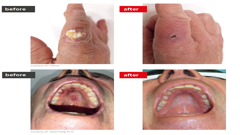 Laser wart removal treatment on the hand at Enfield Royal Clinic in Branchburg, NJ