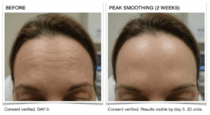 Forehead Botox before and after results using 20 unit