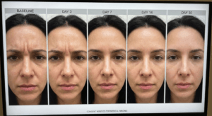 Glabellar Botox results progression from day 3 to day 30