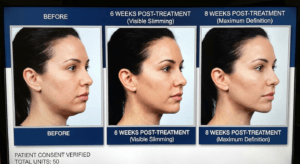 Masseter Botox before and after jawline slimming results