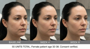 Masseter Botox results progression at 4 and 8 weeks