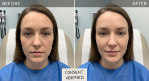 Preventative Botox before and after natural results