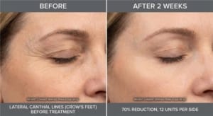 Crow’s feet Botox before and after results
