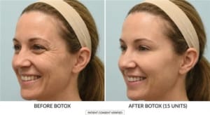 Side view crow’s feet Botox results during smiling