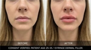 Before and after lip filler for volume and hydration