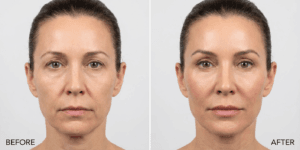 Subtle cheek filler before and after