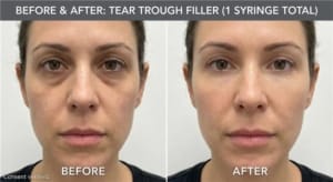 Before and after tear trough filler using 1 syringe for under-eye hollows