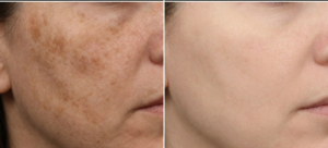 Side-by-side comparison showing significant reduction in dark spots and melasma on a woman's cheek before and after 3 sessions of microneedling.