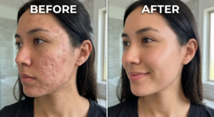  Split screen comparison showing deep rolling acne scars on the left versus smoothed, healed skin texture on the right after microneedling.