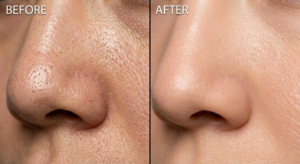 Extreme close-up of nose and cheek skin showing oily, enlarged pores on the left and tightened, refined pores on the right.