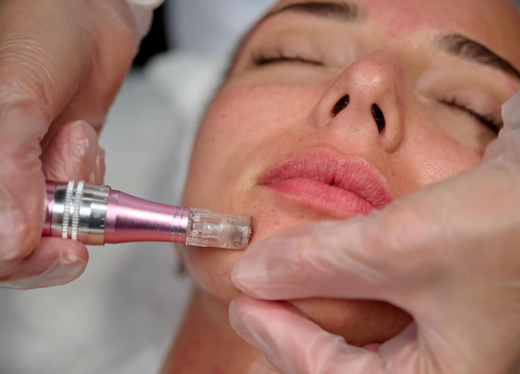 Patient receiving exosome therapy for skin rejuvenation in Tomball, TX