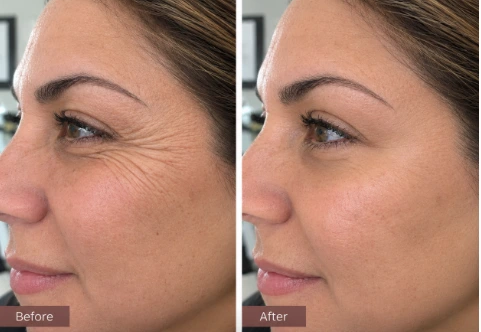 Botox crow’s feet before and after showing softened wrinkles around the outer eye area in Tomball, Texas.